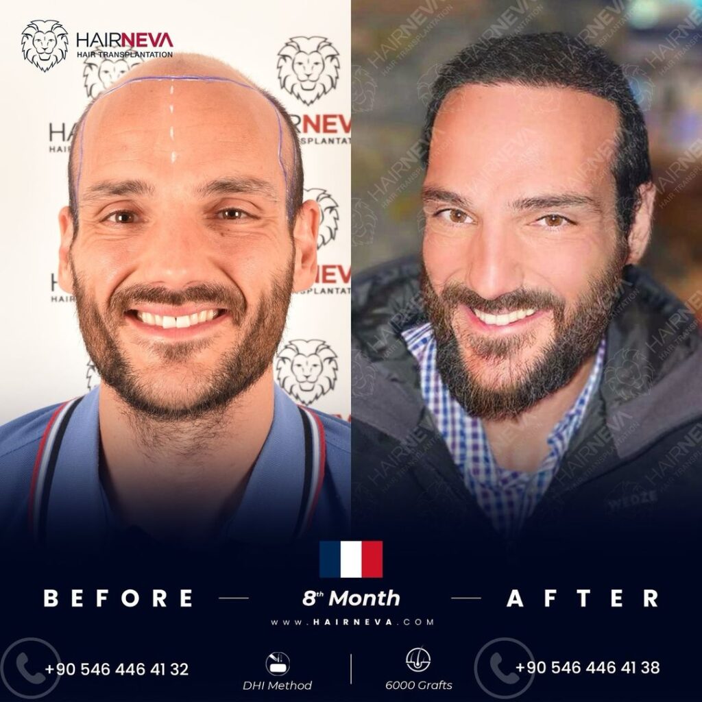 Greffe de cheveux DHI - Evolution jour par jour Hairneva Istanbul Turquie - Hair transplant Hairneva